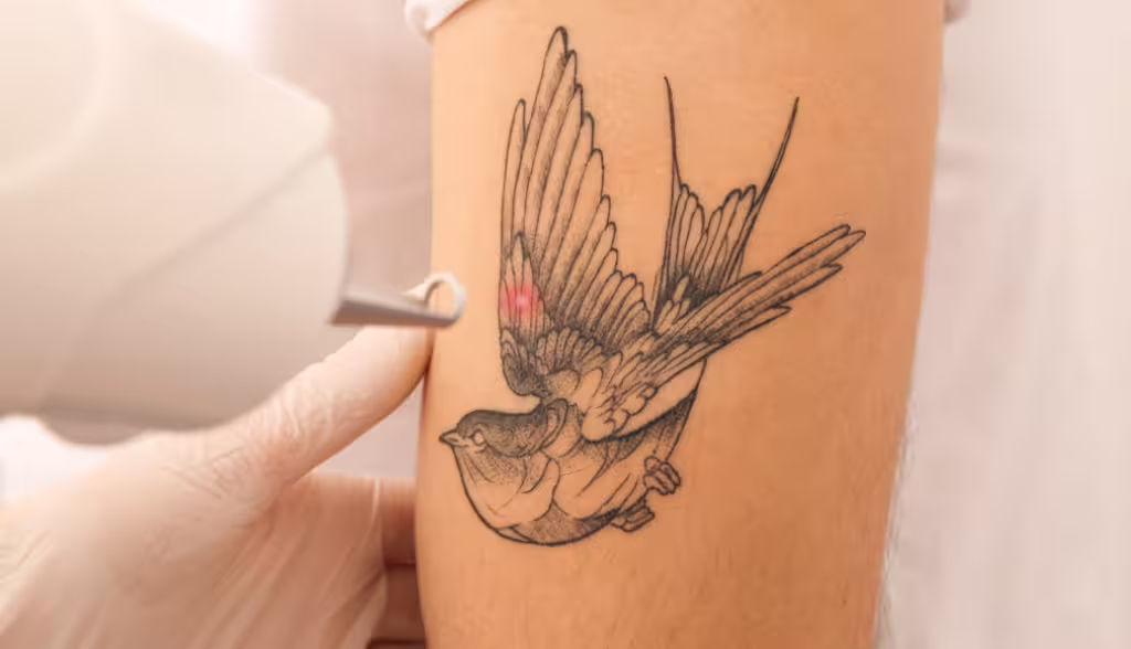 Eliminación de tatuajes con láser en Bogotá