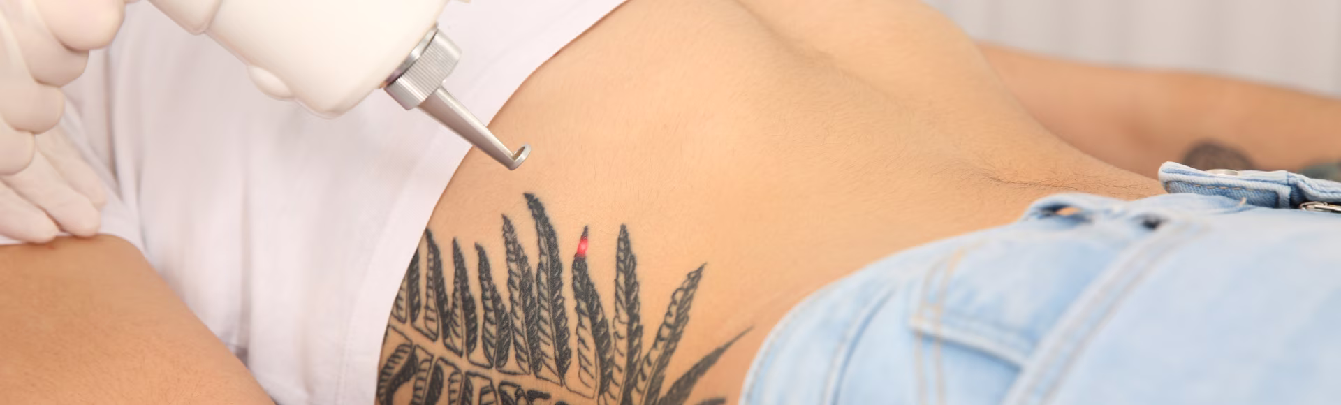 Borrando un tatuajes de una pierna para una paciente de Bogotá que visitó a la Dra. Tatiana Leal