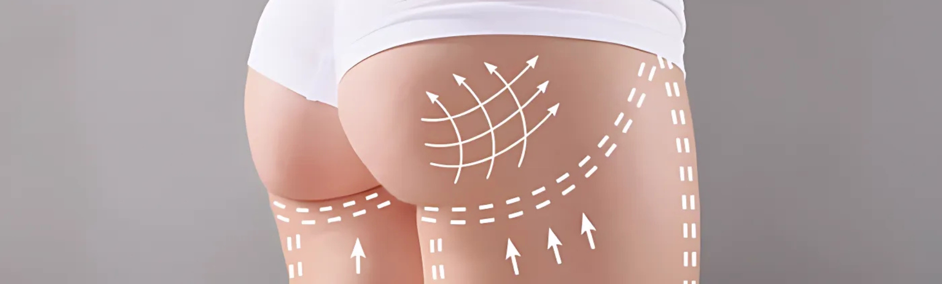 Paciente en una sesión de aumento de glúteos con Sculptra en la clínica de la Dra. Tatiana Leal en Bogotá